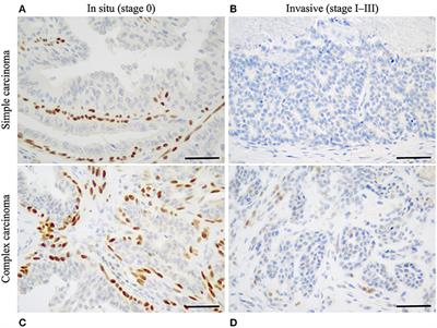 Proposal for a Histological Staging System of Mammary Carcinomas in Dogs and Cats. Part 1: Canine Mammary Carcinomas